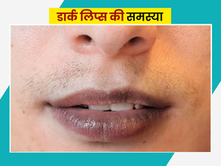 क्या आप डार्क लिप्स की समस्या से परेशान हैं तो, अपनाएं ये 7 घरेलू नुस्खे