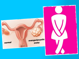 क्‍या पॉलीसिस्टिक ओवरी सिंड्रोम (PCOS) को बि‍ना दवाओं के ठीक क‍िया जा सकता है? जानें क्‍या कहते हैं डॉक्‍टर