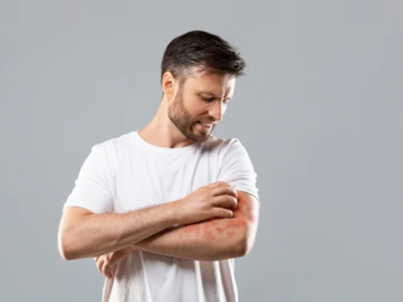 7 Common Myths And Misunderstandings About Psoriasis Skin Disease