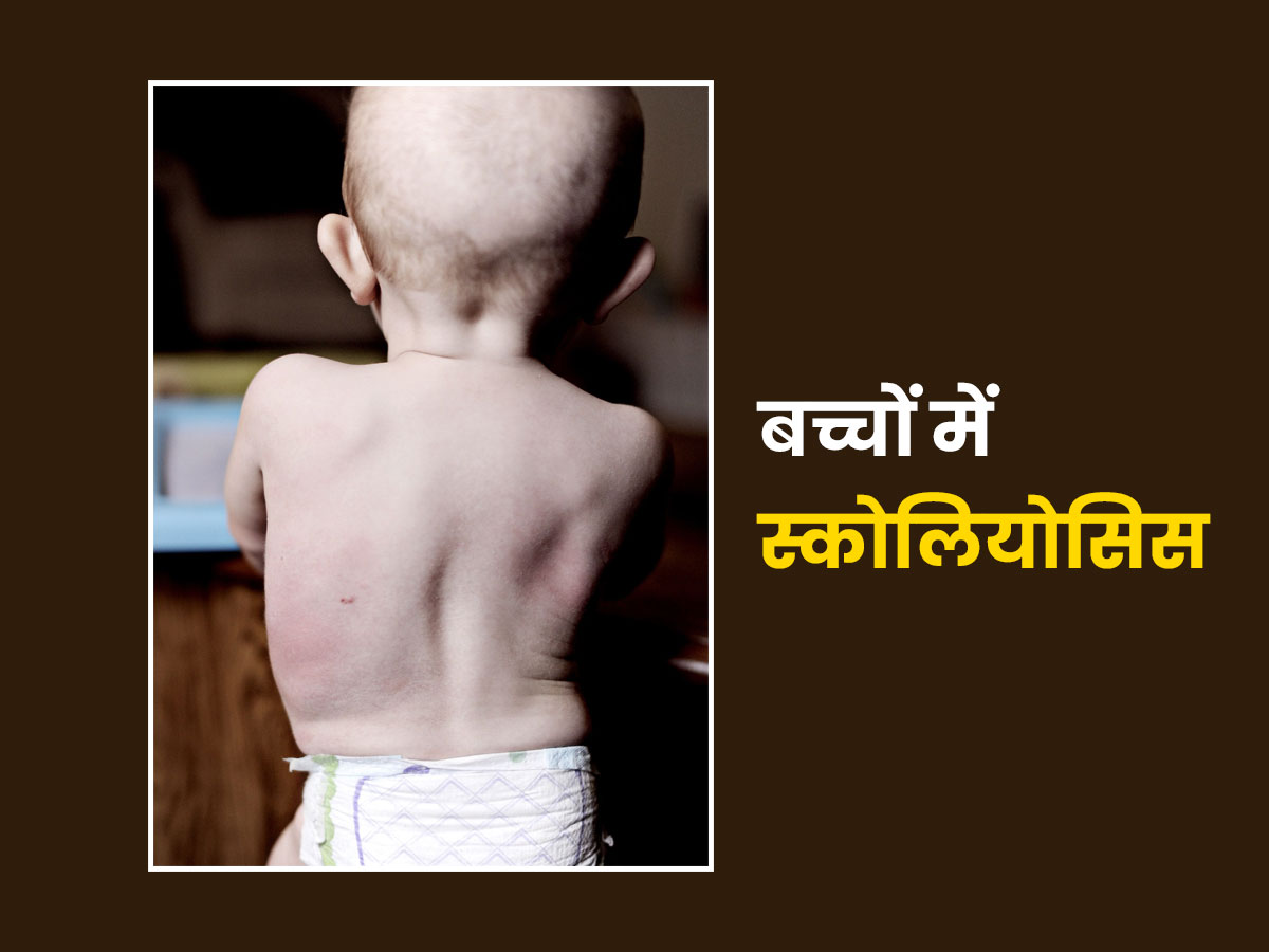 Scoliosis Causes And Symptoms In Kids In Hindi बच च म स क ल य स स क क रण लक षण और उपच र