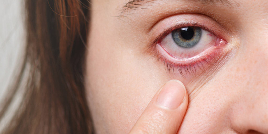 UV Light Exposure to Eyes Symptoms and Prevention in Hindi सूरज की