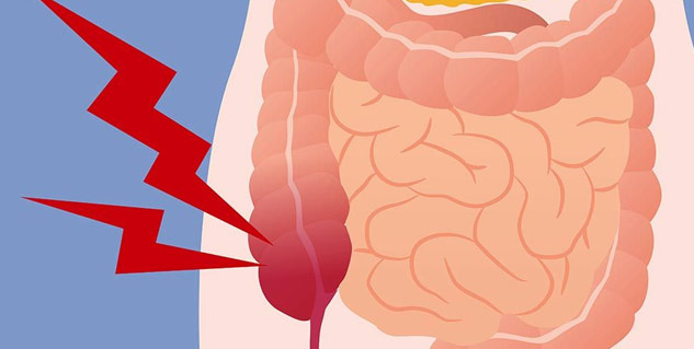 Inside3Appendicitis