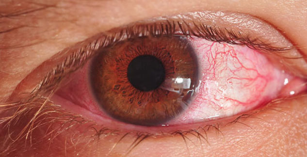 eye infection