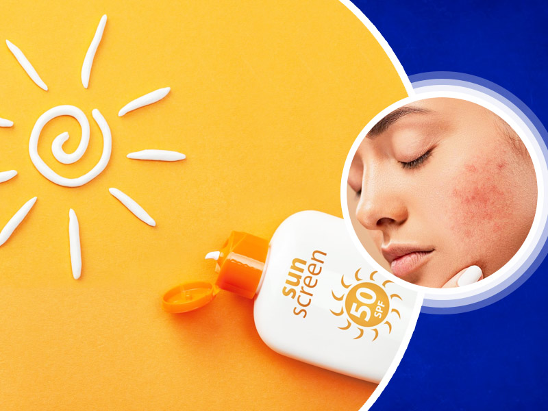 क्या सनस्क्रीन लगाने से हो रहे हैं मुंहासे? जानें कैसे चुनें मुंहासे वाली सेंसिटिव त्वचा के लिए सही सनस्क्रीन