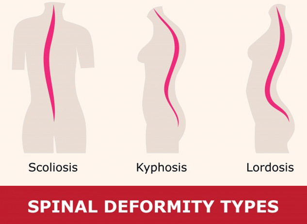 Lordotic Posture: Types, Causes & Exercises For Posture Correction