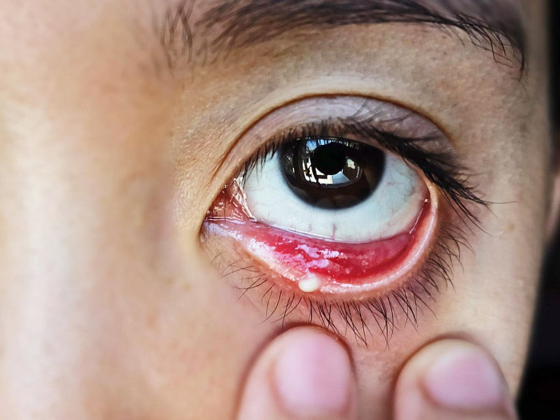 आंखों के अंदर ट्यूमर (ऑर्बिटल ट्यूमर) के क्या हो सकते हैं कारण? डॉक्टर से जानें इसके लक्षण और इलाज के तरीके