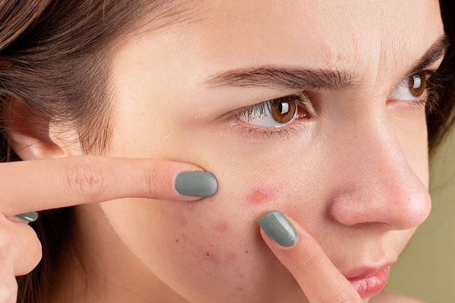 9-home-remedies-for-popped-pimples-and-redness-on-skin