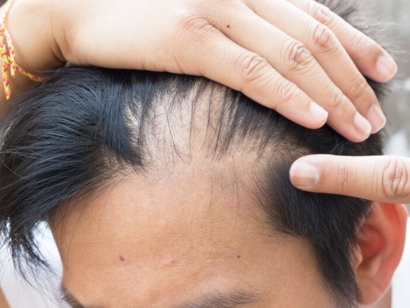 Causes of Hair loss in Young Age in Hindi | क्या कम उम्र में ही झड़ने लगे  हैं आपके बाल? डॉक्टर से जानें इसके 9 कारण