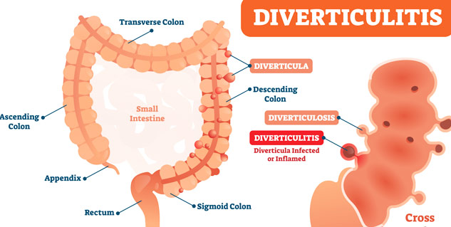 All You Need To Know About Diverticulitis: Symptoms, Causes And ...