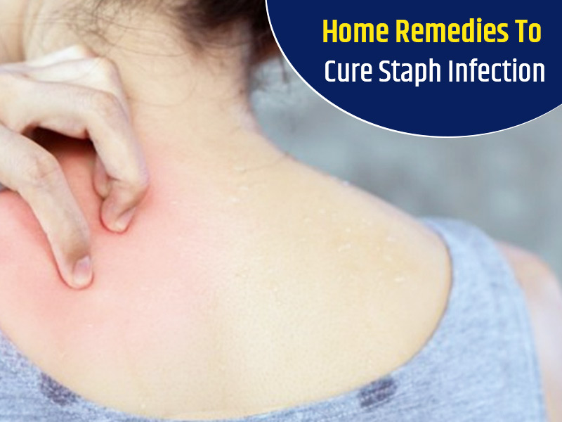 Try Out These 5 Home Remedies To Cure Staph Infection