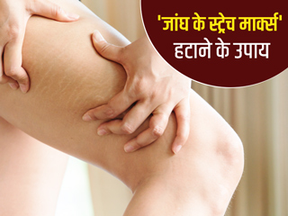 जांघ के स्ट्रेच मार्क्स हटाने के लिए अपनाएं ये 7 घरेलू उपाय