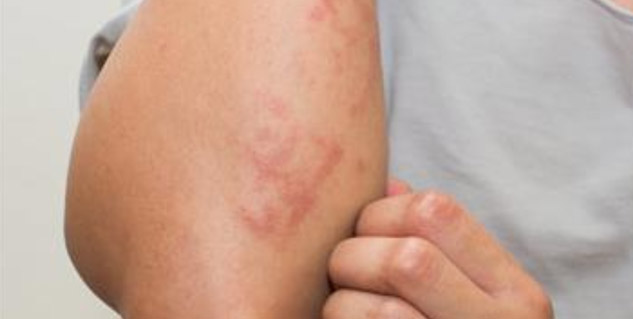 Dengue VS Scrub Typhus: Know Symptoms, Causes, Treatment & Prevention ...