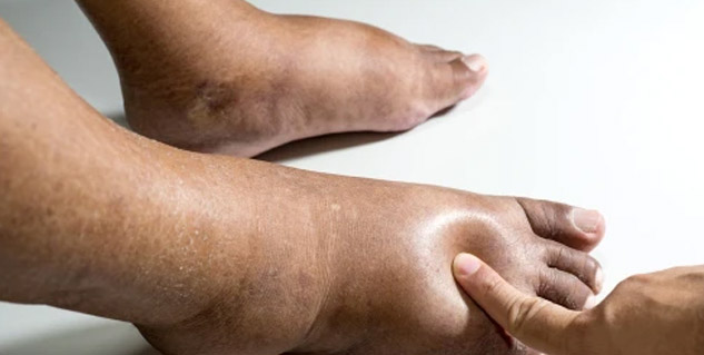 edema or water retention