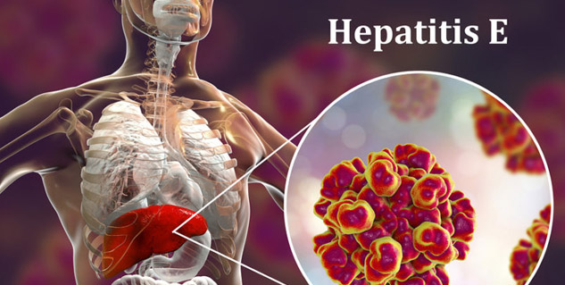 hepatitis E