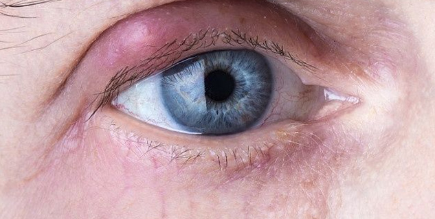 5 Corneal Diseases That Can Cause Serious Damage To Your Eyes ...