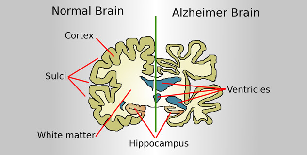 alzhemer disease