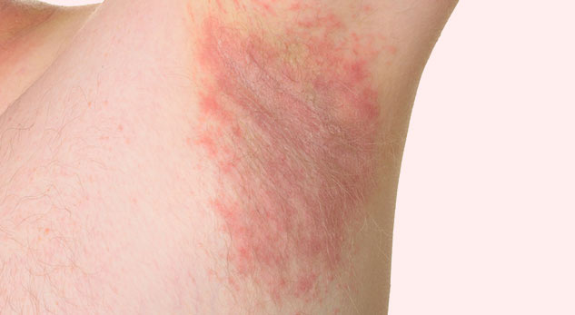 Itching In Armpits? Know These 6 Causes Of Armpit Rashes And Tips