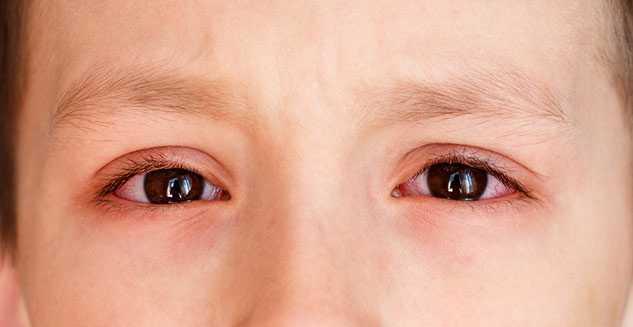 Allergy in Eye