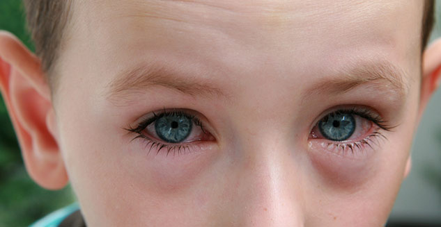 Eye Redness