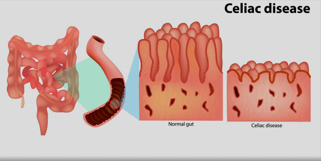 Allergic To Gluten? Know These 3 Types of Conditions Affecting