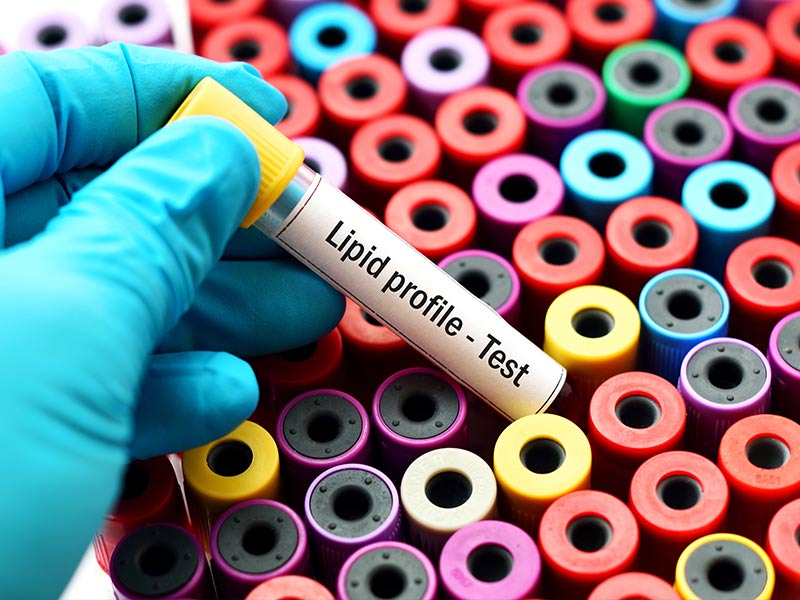 लिपिड प्रोफाइल टेस्ट (Lipid Profile Test) क्या है? डॉक्टर से जानें किन समस्याओं में किया जाता है ये टेस्ट
