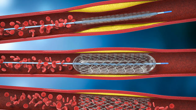 angioplasty