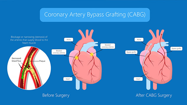 bypass surgery
