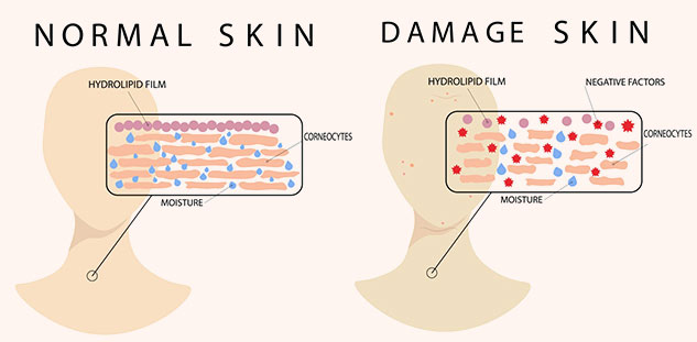 Skin Barrier Damage: Know Symptoms, Causes, Treatment & Prevention ...