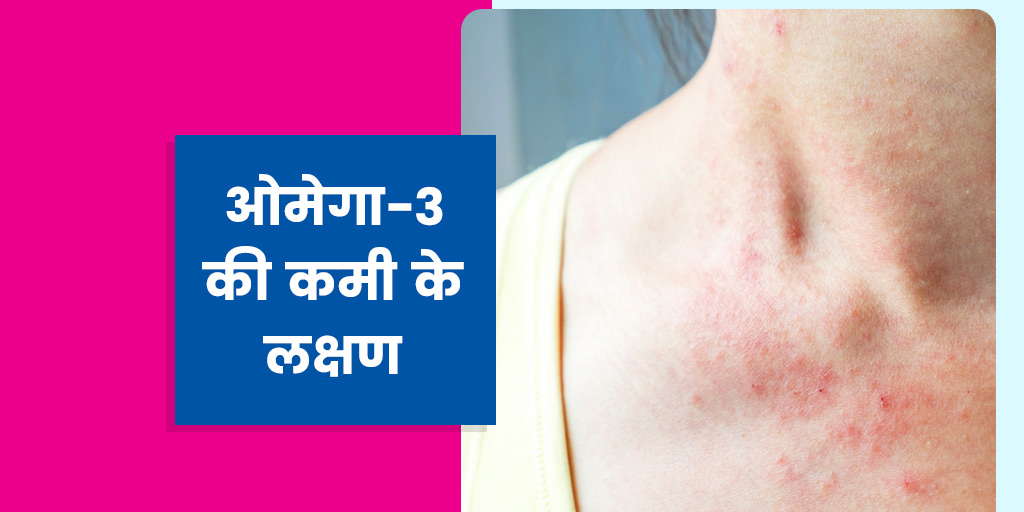 Omega3 deficiency Symptoms Causes and Treatment in hindi ओमेगा3 की