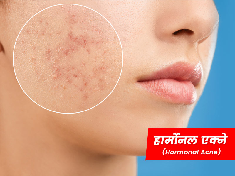 हार्मोन्स के कारण होने वाले मुंहासों (हार्मोनल एक्ने) के लक्षण, कारण और इससे छुटकारा पाने के उपाय