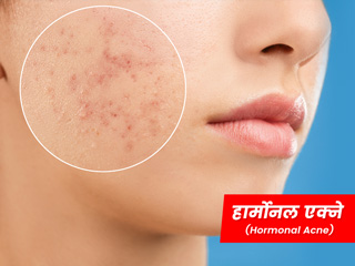 हार्मोन्स के कारण होने वाले मुंहासों (हार्मोनल एक्ने) के लक्षण, कारण और इससे छुटकारा पाने के उपाय
