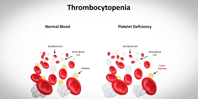 difference_platelet_deficiency