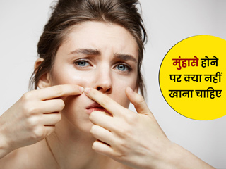 मुंहासे ज्यादा होते हैं तो कम कर दें इन 3 फूड्स का सेवन, बढ़ा सकते हैं आपकी समस्या