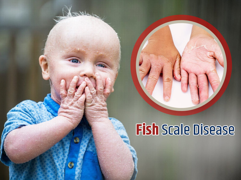 Fish Scale Disease: How Does This Skin Disorder Effect You?