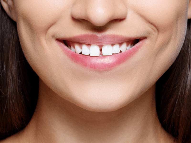 What Causes Gaps Between Teeth? Causes and Treatment
