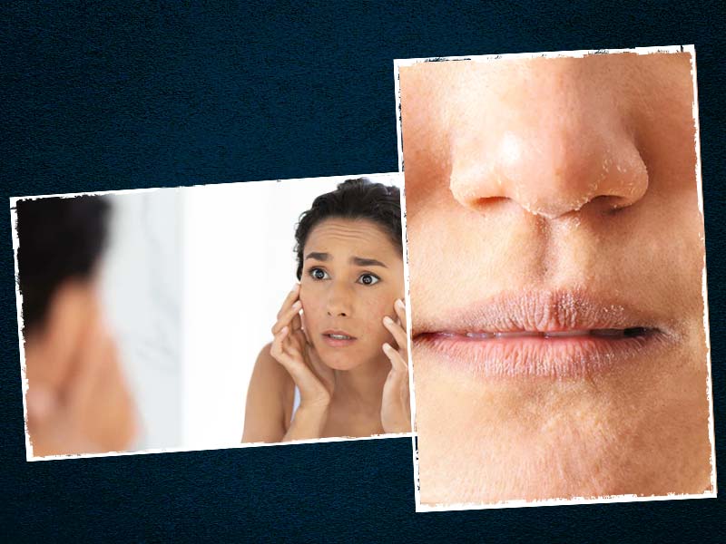 Dealing With Facial Eczema? Here Is How To Treat It At Home