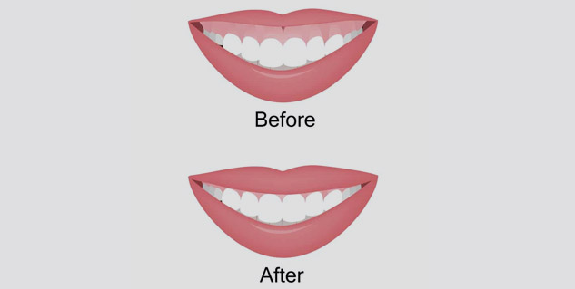 treatment_gummy_smile