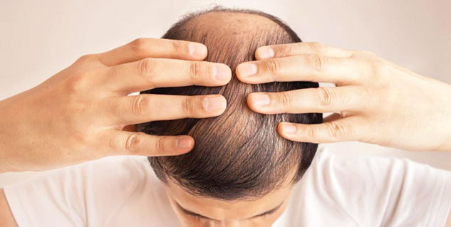 baldness