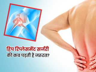 कब पड़ती है हिप रिप्लेसमेंट सर्जरी की जरूरत? जानें इस सर्जरी के बाद जरूरी सावधानियां