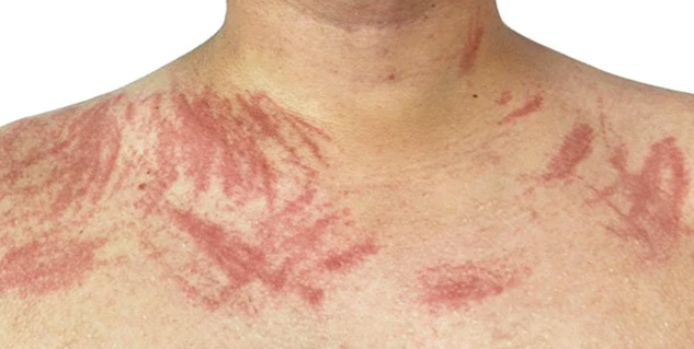 Dermatographia-in-Hindi