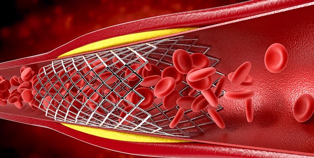 heart angioplasty in hindi