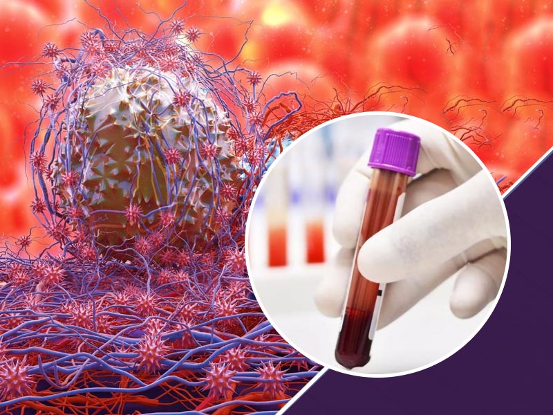 New Blood Test For Cancer Detection: How Does It Work?