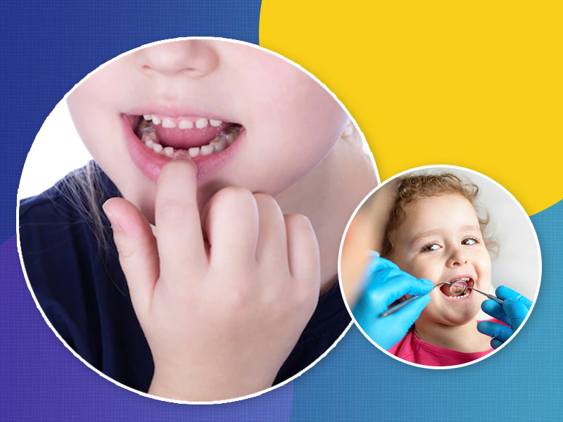 How Do I Keep My Child Cavity Free During Early Childhood?