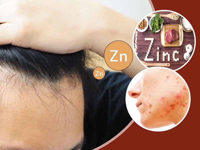 What Is Zinc Deficiency? Know Ways To Treat This Condition