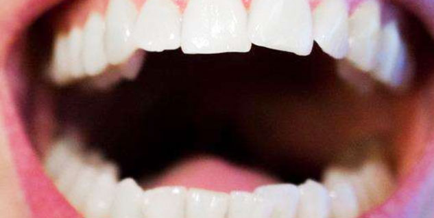 Home-Remedies-For-Black-Gums