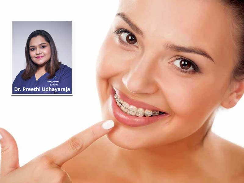 What Is Clear Aligner Therapy? Know How To Get This Orthodontic Treatment By Expert