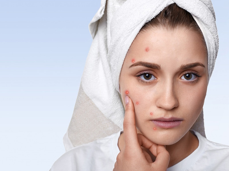 red-sores-on-the-face-here-are-9-effective-home-remedies-for-impetigo