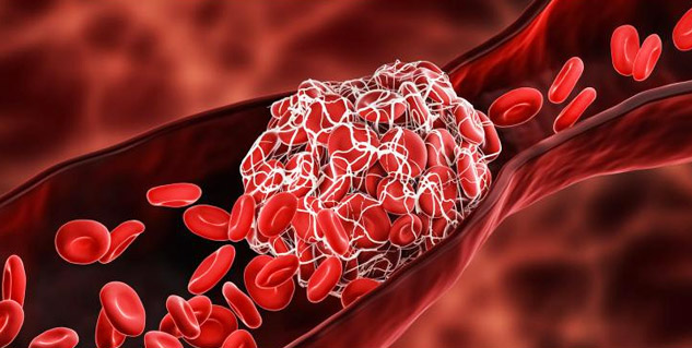 Hemophilia