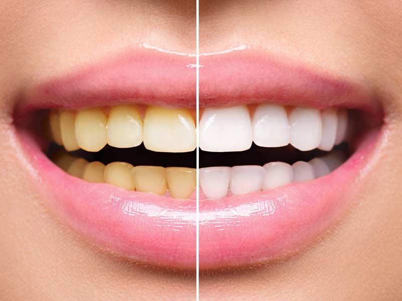 charcoal teeth whitening side effects