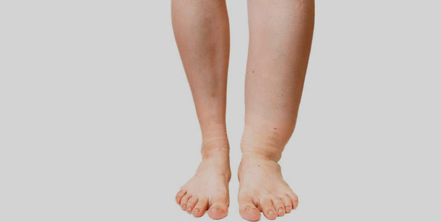 Filaria-Early-Symptoms